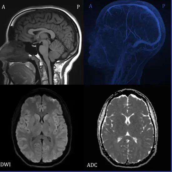 MRI Brain + DWI (Diffusion Weighted Imaging)
